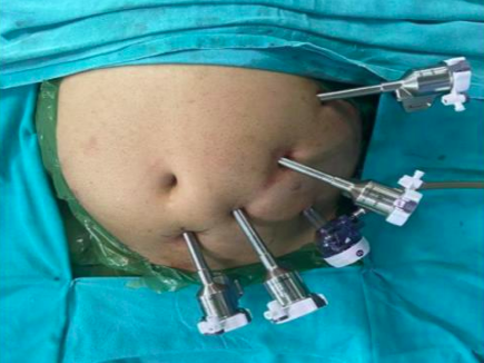Best Laparoscopic Surgery in Delhi